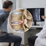 découvrez comment la protrusion discale et le pincement discal peuvent se combiner, leurs mécanismes et leurs effets on la colonne vertébrale.